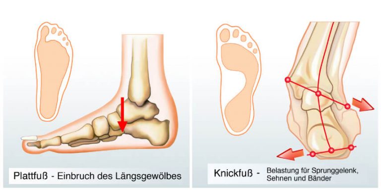 Plattfuß bei Erwachsenen & Kindern » Schmerzen behandeln