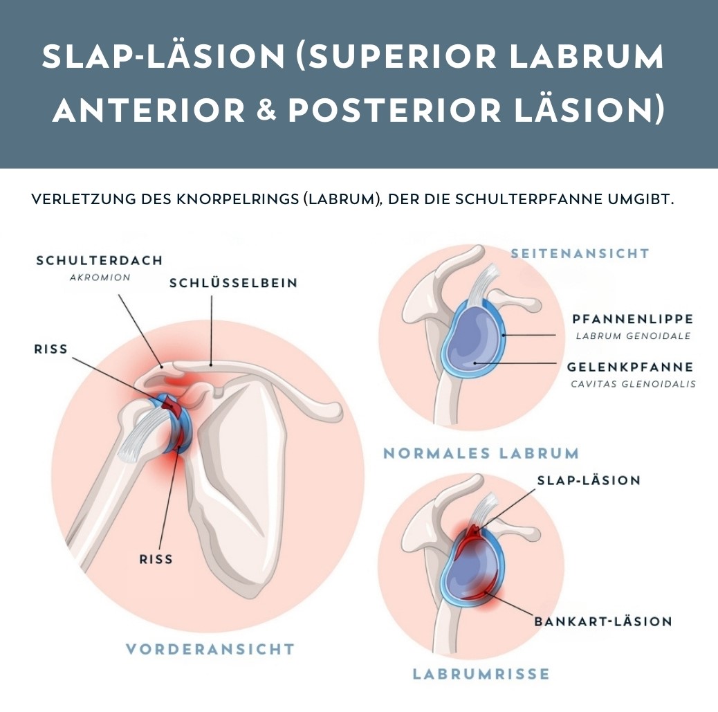 SLAP Läsion Schulter » Therapie & Op » OrthoCenter München