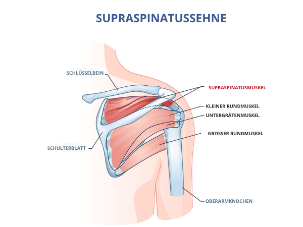 Grafische Darstellung von Supraspinatus.