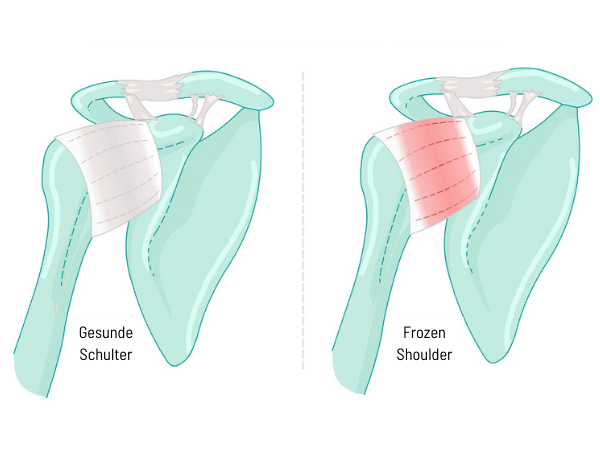 Vergleich einer gesunden Schulter mit einer steifen Schulter.