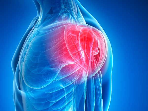 Darstellung einer Frozen Shoulder.