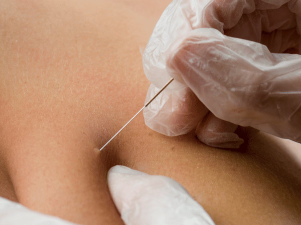 Nahaufnahme Dry Needling.